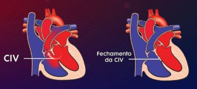 Comunicação Interventricular (CIV)