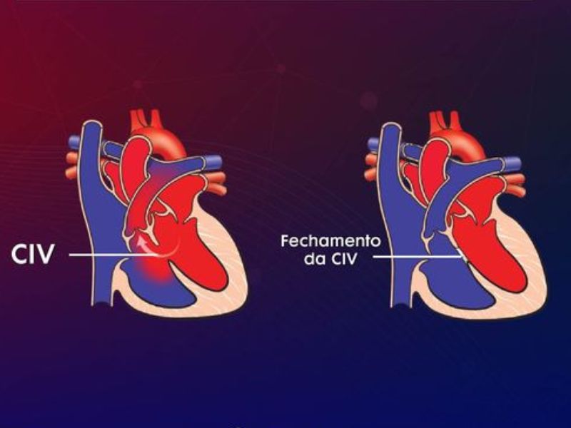 Comunicação Interventricular (CIV)